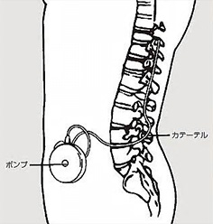 ITBトライアル入院