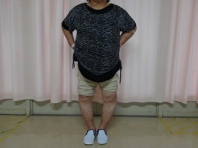 人工膝関節置換術（TKA：Total Knee Arthroplasty）理学療法(PT